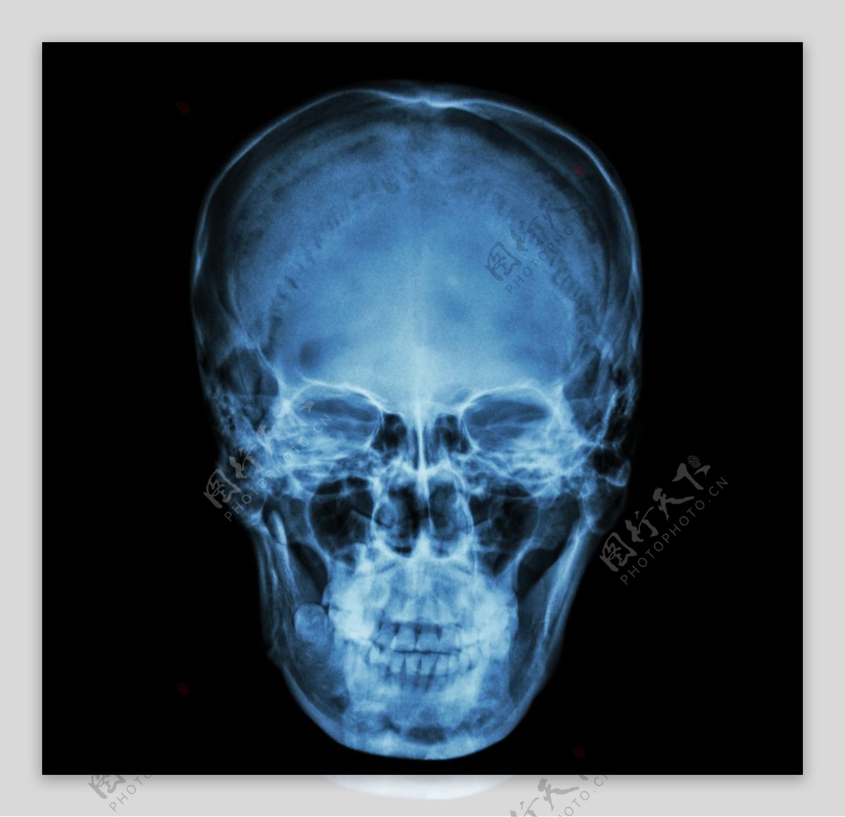 X射线图片