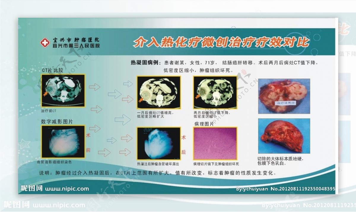 介入热化疗疗效图片