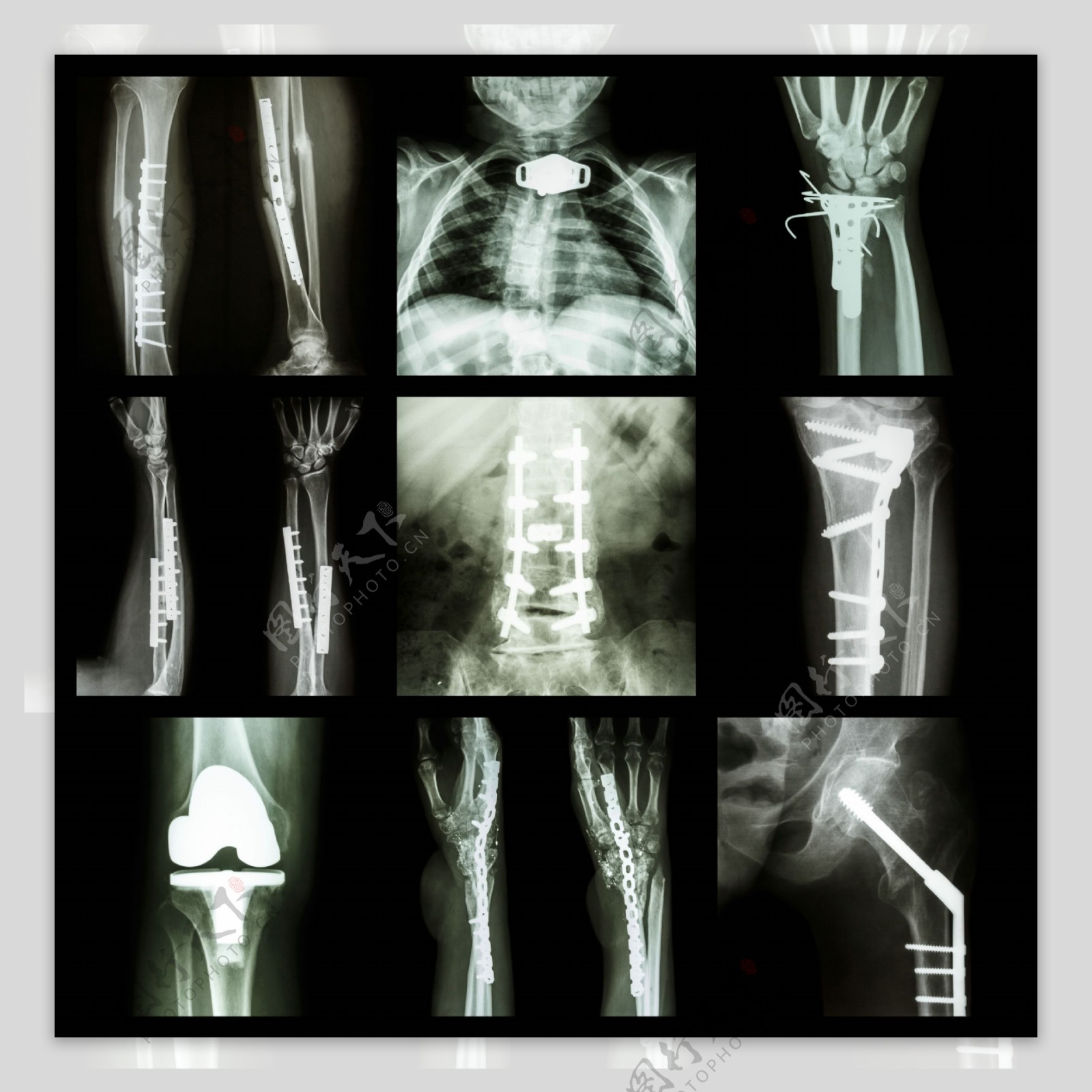 人体X光片图图片